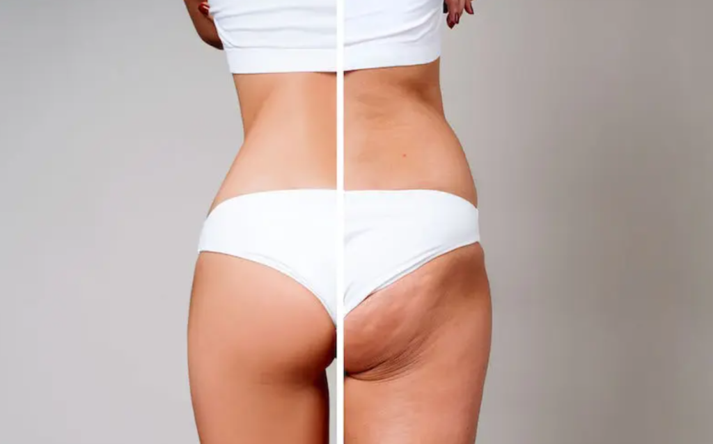 Cellulite Gone